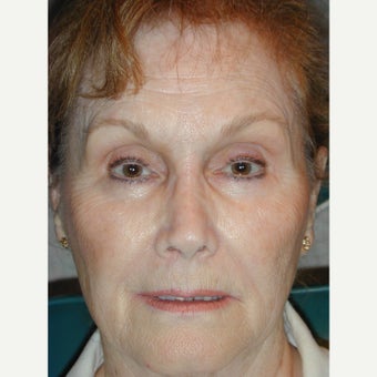 55-64 year old woman treated with Non Surgical Nose Job after 2413296