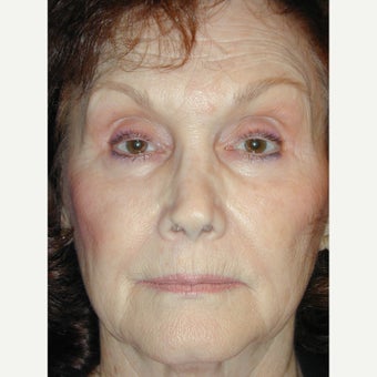 55-64 year old woman treated with Non Surgical Nose Job before 2413296