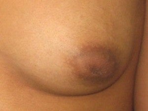 Nipple Surgery before 1078045