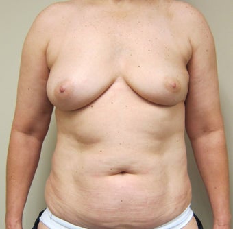 50-year-old female with bilateral immediate DIEP flap breast reconstruction before 698989