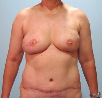 50-year-old female with bilateral immediate DIEP flap breast reconstruction after 698989