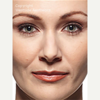 Nasolabial Folds before 3065347