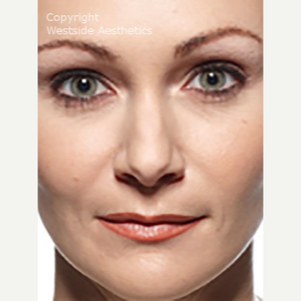 Nasolabial Folds after 3065347