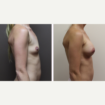 25-34 year old woman treated with Breast Augmentation after 3300140