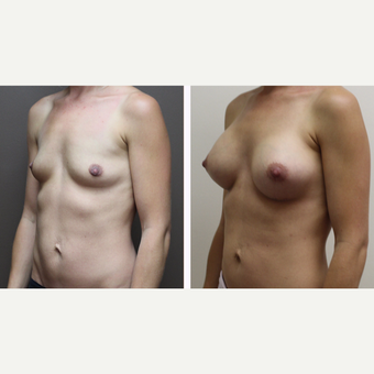 25-34 year old woman treated with Breast Augmentation before 3300140