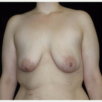 26 year old woman treated with Breast Lift with Implants after Weight Loss before 3251786