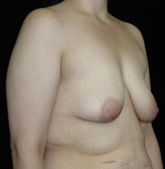 26 year old woman treated with Breast Lift with Implants after Weight Loss 3251786