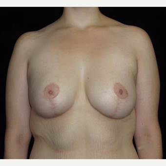 26 year old woman treated with Breast Lift with Implants after Weight Loss after 3251786