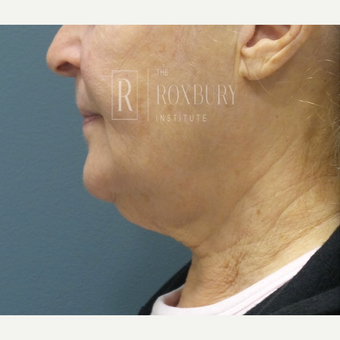 65-74 year old woman treated with Wrinkle Treatment before 3777571