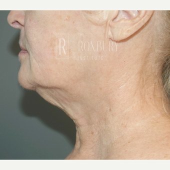 65-74 year old woman treated with Wrinkle Treatment after 3777571