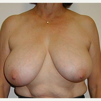 62 year old woman treated with Breast Reduction using a "Wise Pattern" ("T", anchor) technique before 2474343