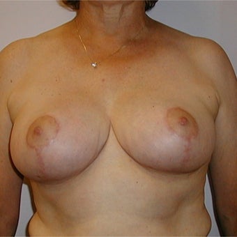 62 year old woman treated with Breast Reduction using a "Wise Pattern" ("T", anchor) technique after 2474343