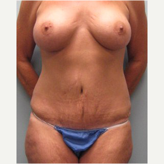 56 year old woman treated with Mommy Makeover after 3468557