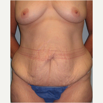 56 year old woman treated with Mommy Makeover before 3468557