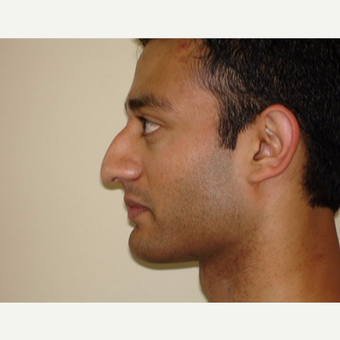 25-34 year old man treated with Rhinoplasty before 3371447