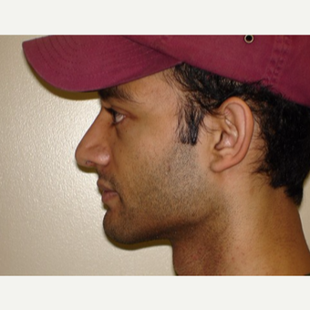 25-34 year old man treated with Rhinoplasty after 3371447