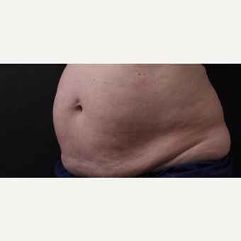 59 year old woman treated with CoolSculpting before 3384609