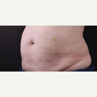 59 year old woman treated with CoolSculpting after 3384609
