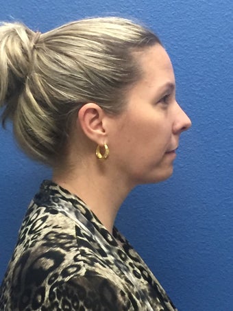 35-44 year old woman treated with Chin Implant after 2903603