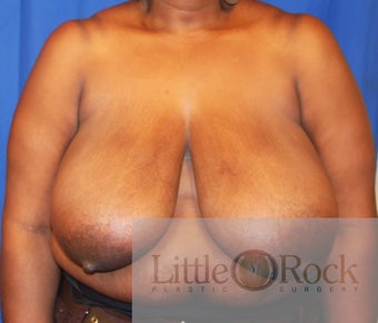 Breast reduction before 1229310