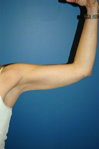 liposuction arms after 1055063