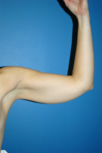 liposuction arms before 1055063
