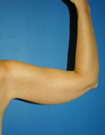 liposuction arms 1055063