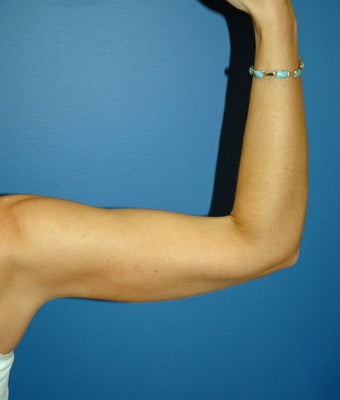 liposuction arms 1055063