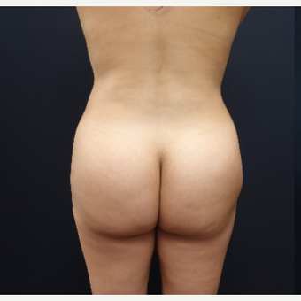 25-34 year old woman treated with Brazilian Butt Lift Revision before 3286168