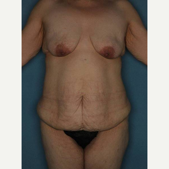 35-44 year old woman treated with Body Lift before 3402336