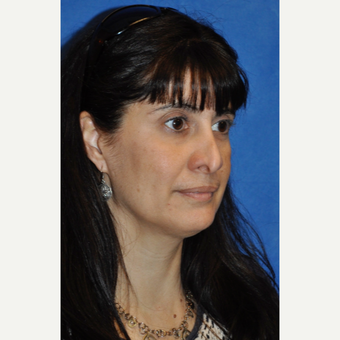 45-54 year old woman treated with Revision Rhinoplasty before 3248025