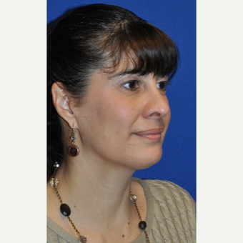 45-54 year old woman treated with Revision Rhinoplasty after 3248025