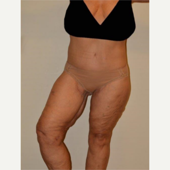 55-64 year old woman treated with Thigh Lift after 3659675