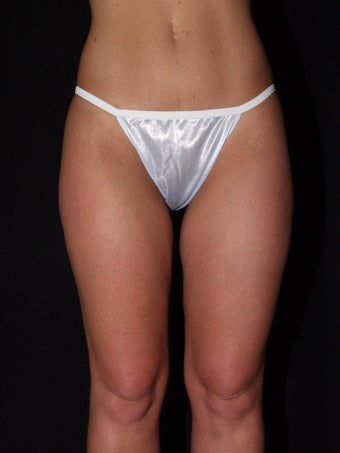 32 year-old female with excess fat on her thighs before 1190932