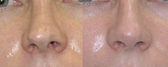 Revision Rhinoplasty before 548869