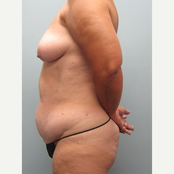 52 year old woman treated with Mommy Makeover before 3680086