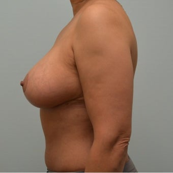 Liposuction, tummy tuck, and breast reduction on 50 year old Mommy Makeover patient after 2440757