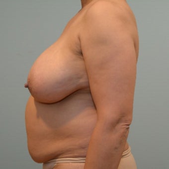 Liposuction, tummy tuck, and breast reduction on 50 year old Mommy Makeover patient before 2440757