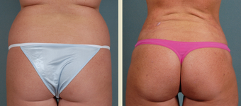 Fat Transfer before 1376876