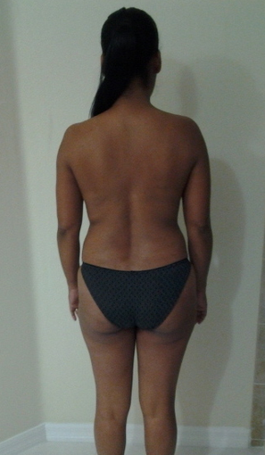 4 weeks after surgery. Liposuction + fat transfer to butt (Brazilian Butt Lift) before 979674