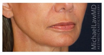 Fat Grafting after 1199028