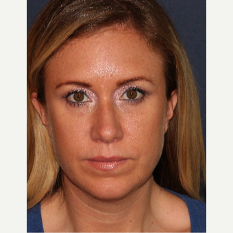25-34 year old woman treated with Restylane after 3149531