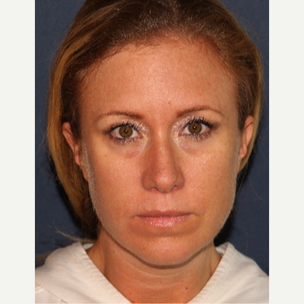 25-34 year old woman treated with Restylane before 3149531