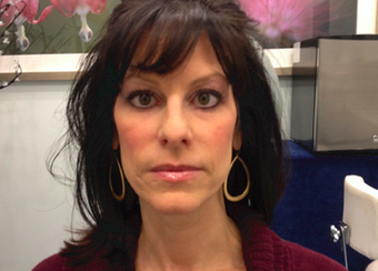 Cheek augmentation and cheek enhancement before 1183030