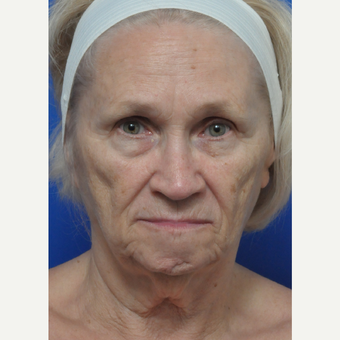 Woman treated with Contoura before 3439292