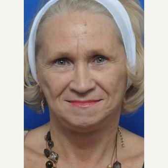 Woman treated with Contoura after 3439292