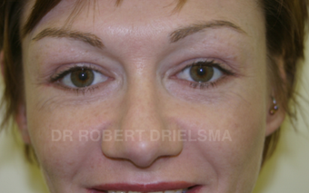 35 yo woman, cheek implants and lower lid blepharoplasty after 1486149