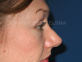 35 yo woman, cheek implants and lower lid blepharoplasty 1486149