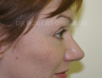 35 yo woman, cheek implants and lower lid blepharoplasty 1486149