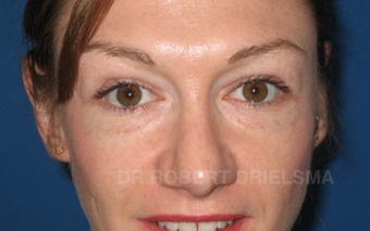 35 yo woman, cheek implants and lower lid blepharoplasty before 1486149